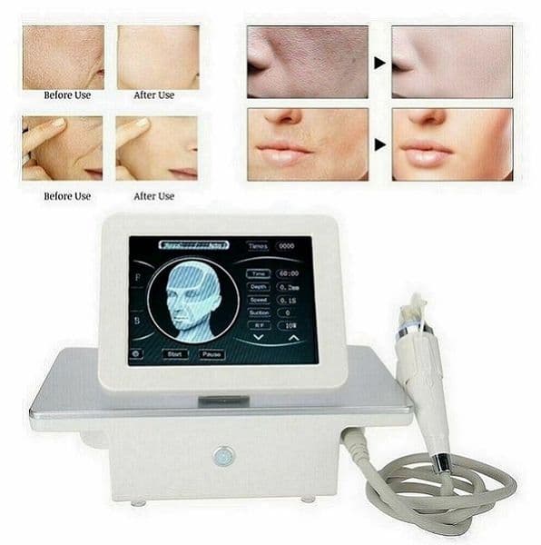 RF Microneedling Machine - Stretch Mark Remover, Fractional Micro-Needle Skin Tightening, Face Lift, Professional Beauty Salon Equipment for Skin Rejuvenation