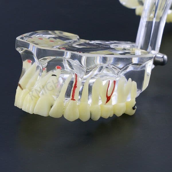 Dental Models Adult Pathology Restorable Models Of Diseased Teeth For Teaching And Researching Medical And Dental Diseases